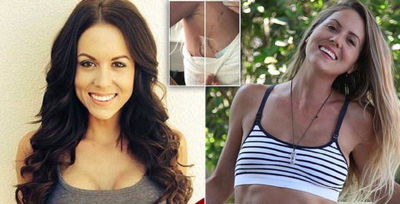 31-летняя австралийка обрела радость жизни, избавившись от грудных
